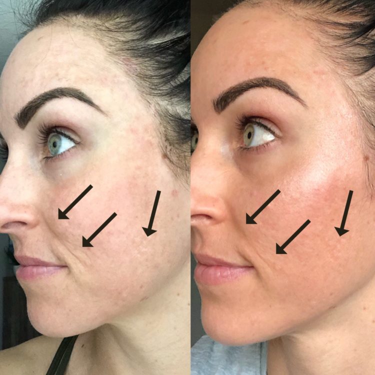 My Experience w/ Microneedling & Why I'm Obsessed PaleOMG