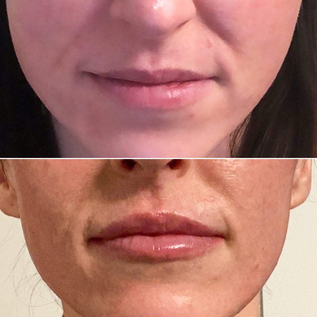 The Lip Filler Facts PaleOMG