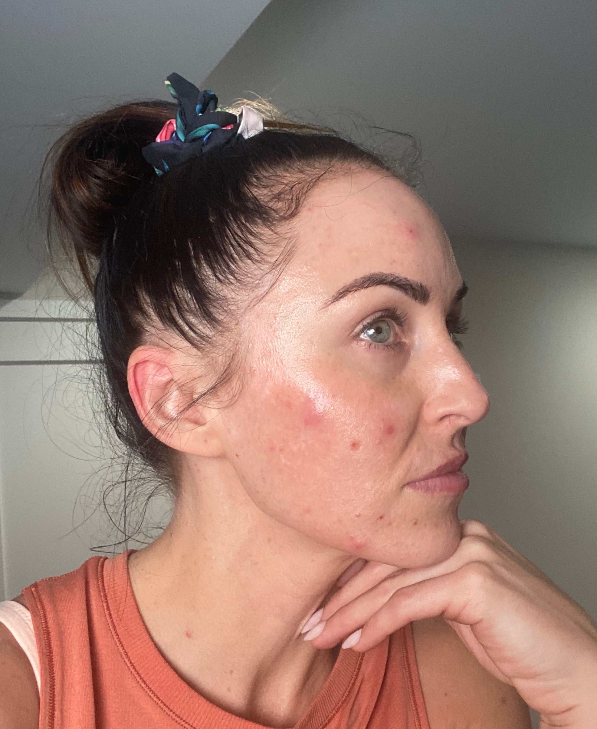 paleo before and after acne